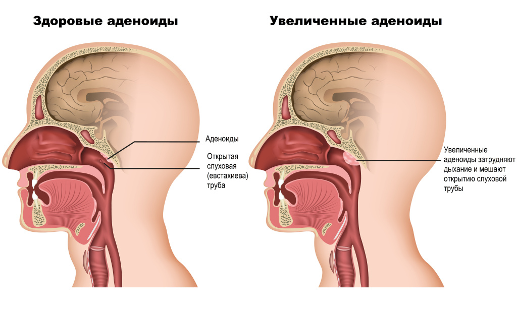 Заложено ухо при рините: почему
