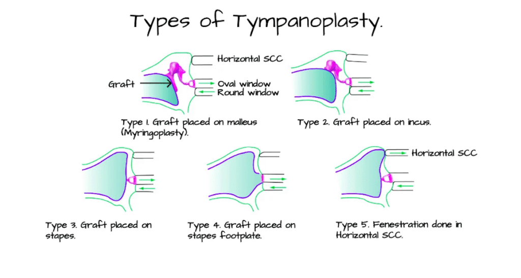 Stages of tympanoplasty
